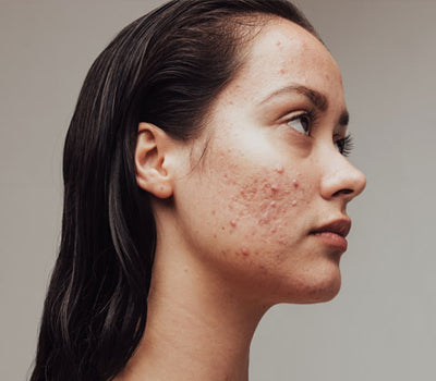 Acne