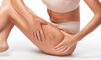 Leg Veins