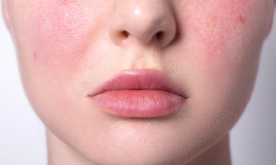 Rosacea