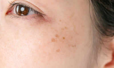 Pigmentation