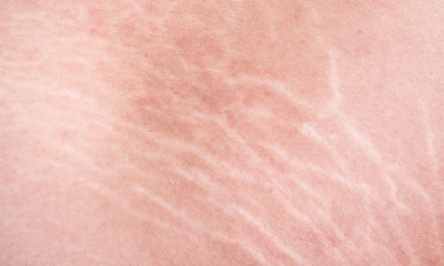 Stretch Marks