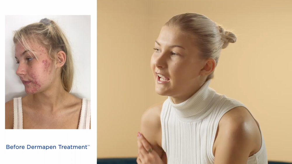 Load video: How Dermapen Treatments™ helped Sami reclaim her clear skin and confidence. An interview with before and after footage.